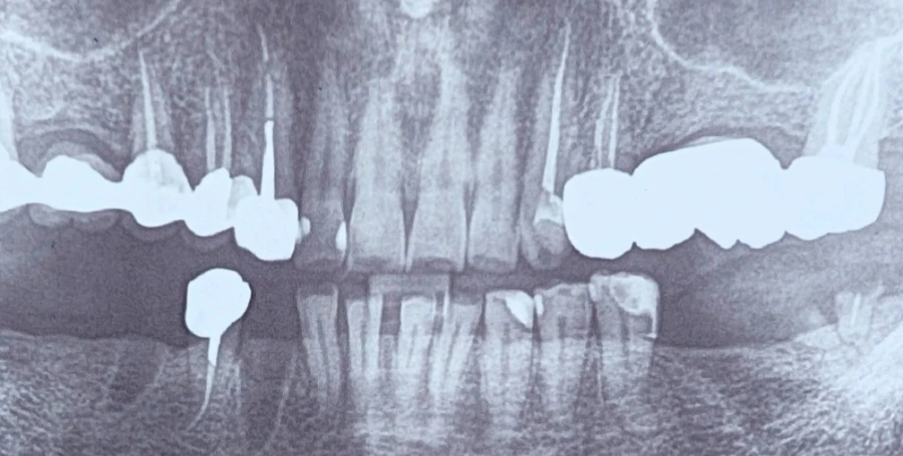 Panoramic radiograph referenced for a bisphosphonate patient with a lower-jaw implant contraindication, insufficient on its own for presenting a definitive treatment plan