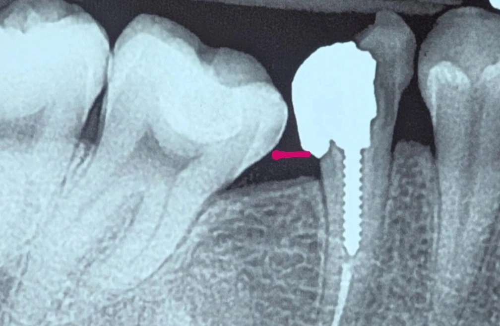 Initial periapical radiograph with an approximate line marking the gingival level next to the severely mesially tilted adjacent tooth