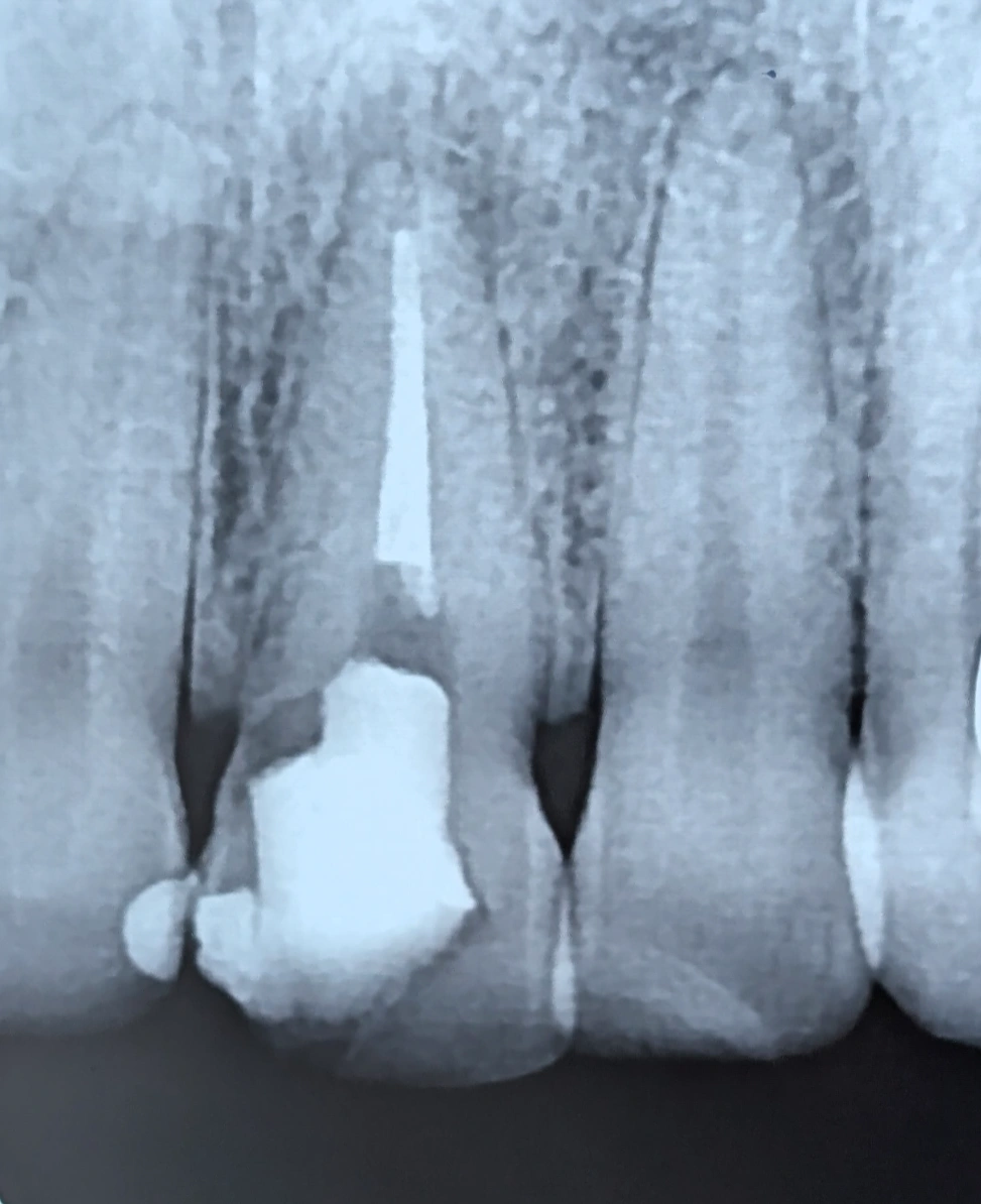 Periapical radiograph showing extensive internal destruction and a very thin mesial wall in a central incisor