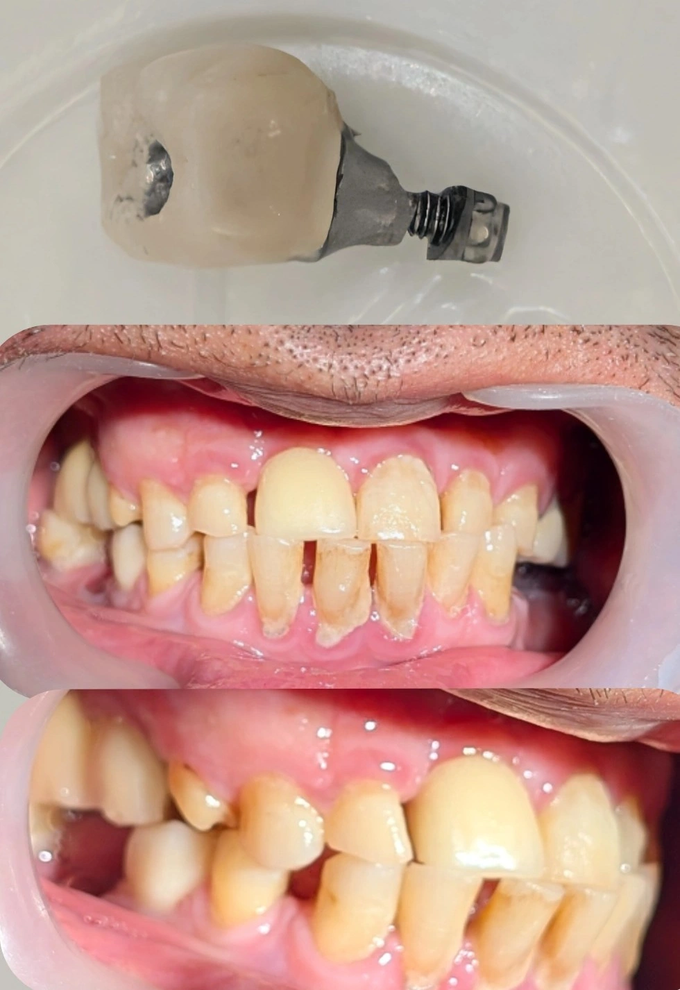 Fractured implant abutment and screw removed from the mouth, alongside intraoral views showing dental attrition and occlusal contacts
