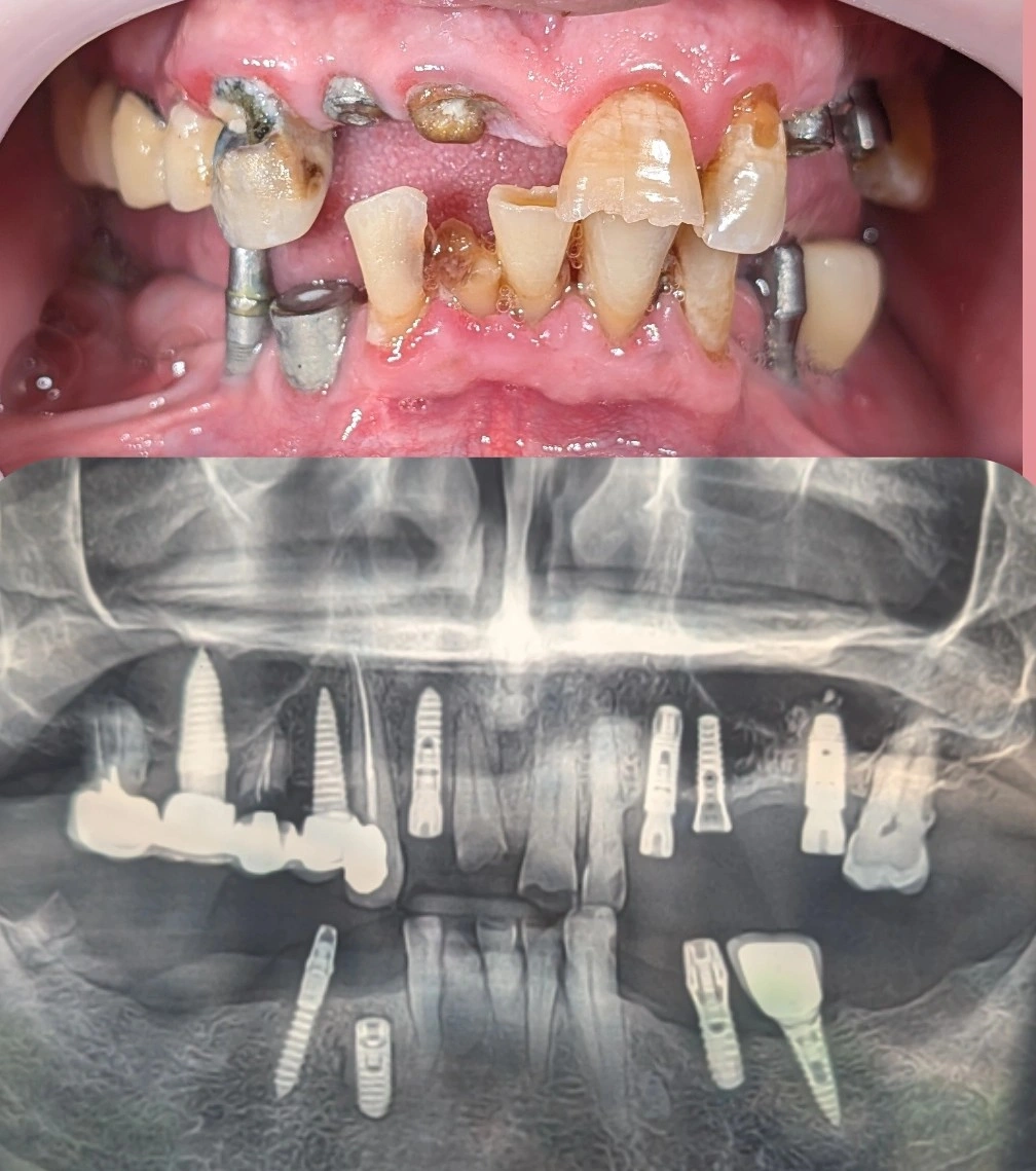 Intraoral view and panoramic radiograph of a complex full-mouth case with multiple existing old implants, exposed abutments, and heavily worn or damaged natural teeth