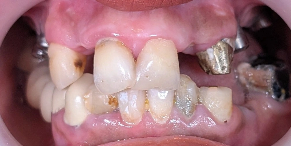 Intraoral photograph of the anterior segment showing existing crowns, an old composite restoration, and visible plaque and calculus indicating poor oral hygiene control