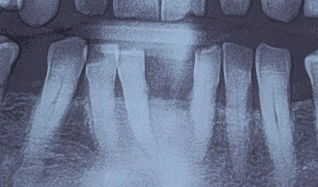 Periapical radiograph of the mandibular anterior region showing a wide diastema between the central incisors with the roots of the adjacent lateral incisors and canines visible