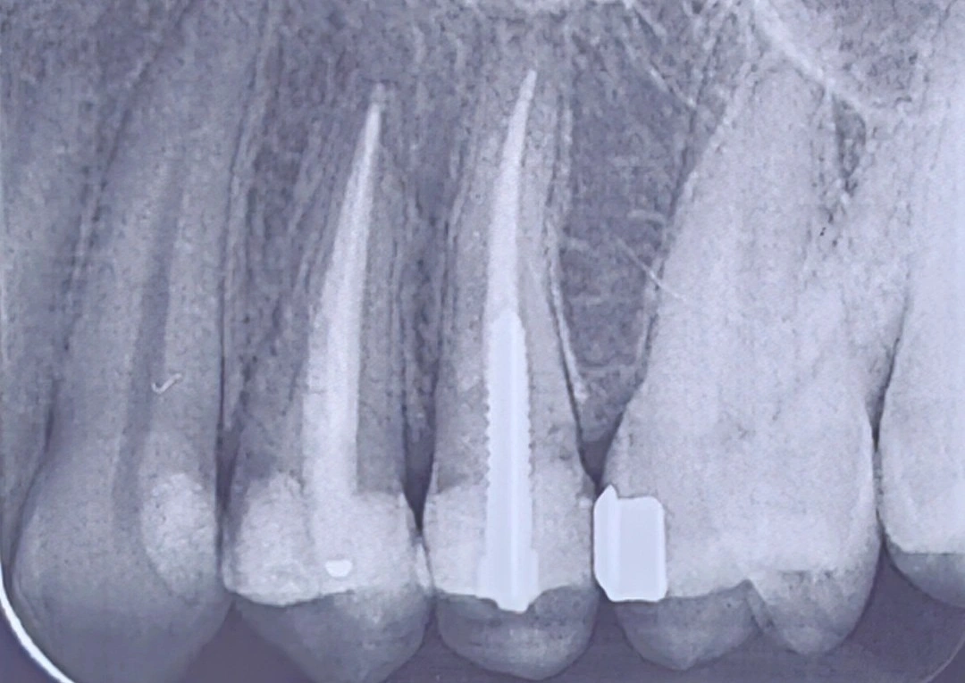Periapical radiograph of a first premolar showing an extensive composite restoration with limited remaining tooth structure
