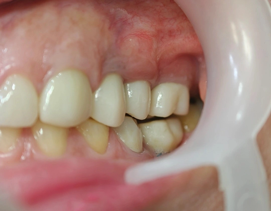 Intraoral view showing short implant crowns on the mandibular second premolar and first molar in infra-occlusion, alongside a supra-erupted mandibular second molar that has consumed the maxillary restorative space.