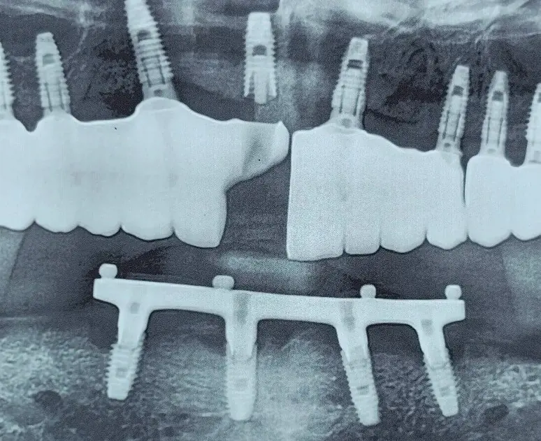 Radiograph of both jaws: a maxillary implant-supported ceramic bridge with a fractured ceramic segment where a crown has separated, opposed by an implant-supported bar in the mandible.