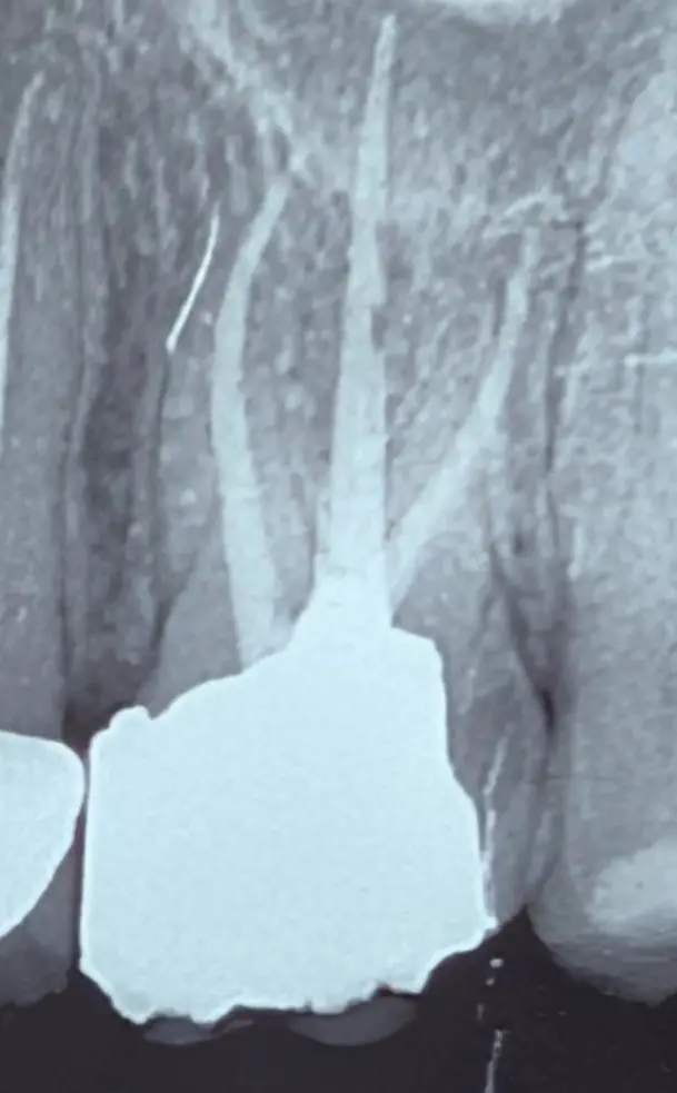 Interproximal restoration contour and biologic width case