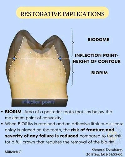 نمودار بایودام و بایوریم روی مقطع دندان با نقاط اینفلکشن، بر اساس مدل Milicich (General Dentistry, 2017)