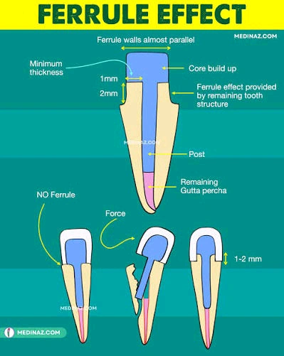 نمودار Ferrule Effect: دیواره‌های تقریباً موازی فرول، حداقل ضخامت و ارتفاع ۱ تا ۲ میلی‌متر، و مقایسه‌ی شکست دندان با و بدون فرول کافی