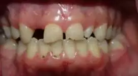 نمای قبل از درمان؛ فقدان لترال راست بالا، لترال مقابل Peg-Shaped و دیاستم.
